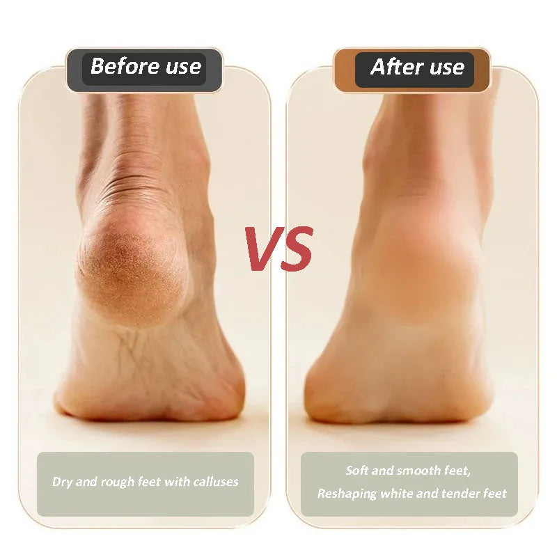 🔥Produit phare🔥Appareil de rajeunissement et de resurfaçage des pieds rechargeable par USB – Obtenez des pieds lisses et doux à tout moment, n’importe où ! 🦶✨